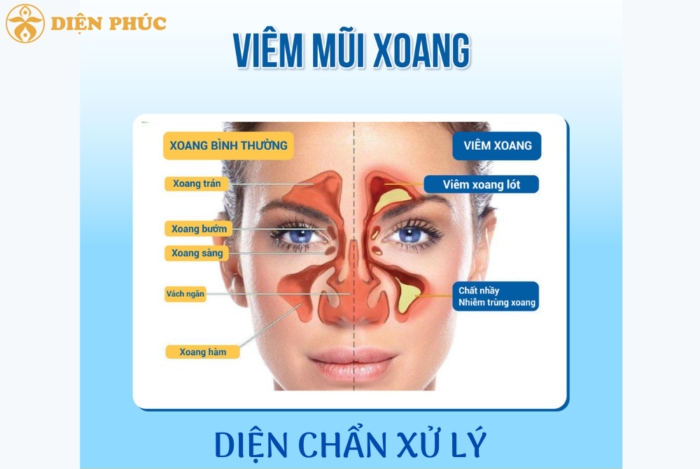 Mẹo Diện Chẩn xử lý viêm xoang